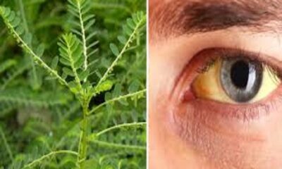 Not only medicines but also these home remedies will cure jaundice, use these things