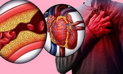 Arteries Blockage home remedies