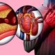 Arteries Blockage home remedies