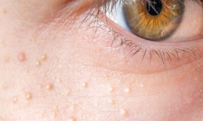 White spots on the face will be clear in minutes, just use these products with aloe vera