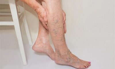 Follow these home remedies to remove vein blockage!