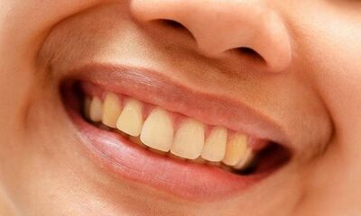 yellow teeth home remedies