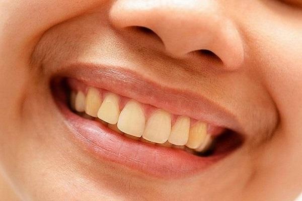 yellow teeth home remedies