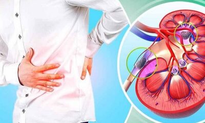 These symptoms of the body indicate that kidney stones have occurred, do not ignore them