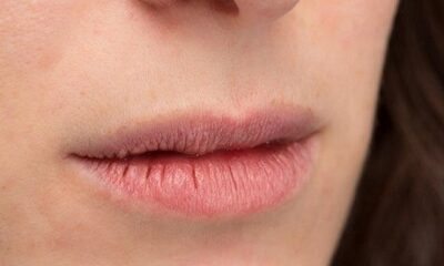 If chapped lips are a problem in winter then follow these home remedies