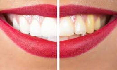 If you are also troubled by yellow teeth, you will get relief from the problem with these native recipes