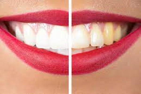 If you are also troubled by yellow teeth, you will get relief from the problem with these native recipes