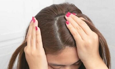 There will be no dandruff in the hair, only these home remedies will give relief from the problem