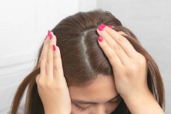 There will be no dandruff in the hair, only these home remedies will give relief from the problem