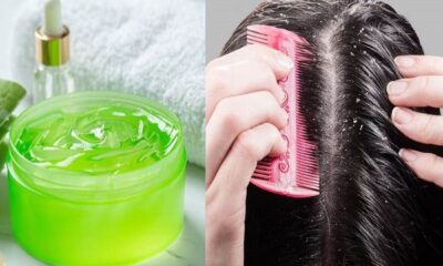 If you want to get rid of dandruff then use aloe vera in these ways