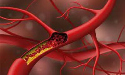 Cholesterol accumulated in nerves will melt, add these foods to your routine