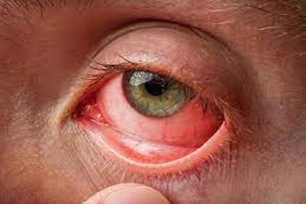 Eye Flu cases started increasing due to rainy season, advisory issued